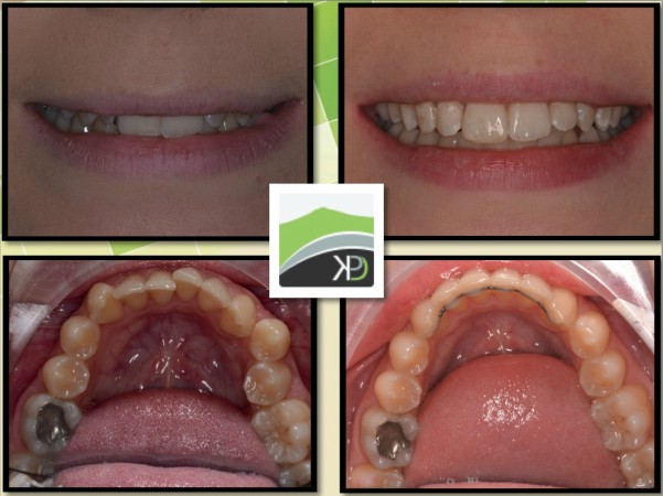 Six Month Smiles Kintore_5